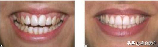 怎么不露齿笑才自然好看,如何笑不露齿笑起来好看的技巧