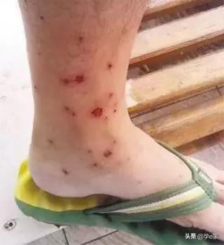 身上出现许多小黑痣,身上出现凸起黑痣一定要重视