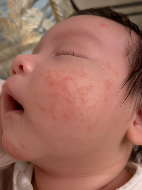 宝宝湿疹严重反反复复怎么办,宝宝湿疹反反复复怎么处理啊