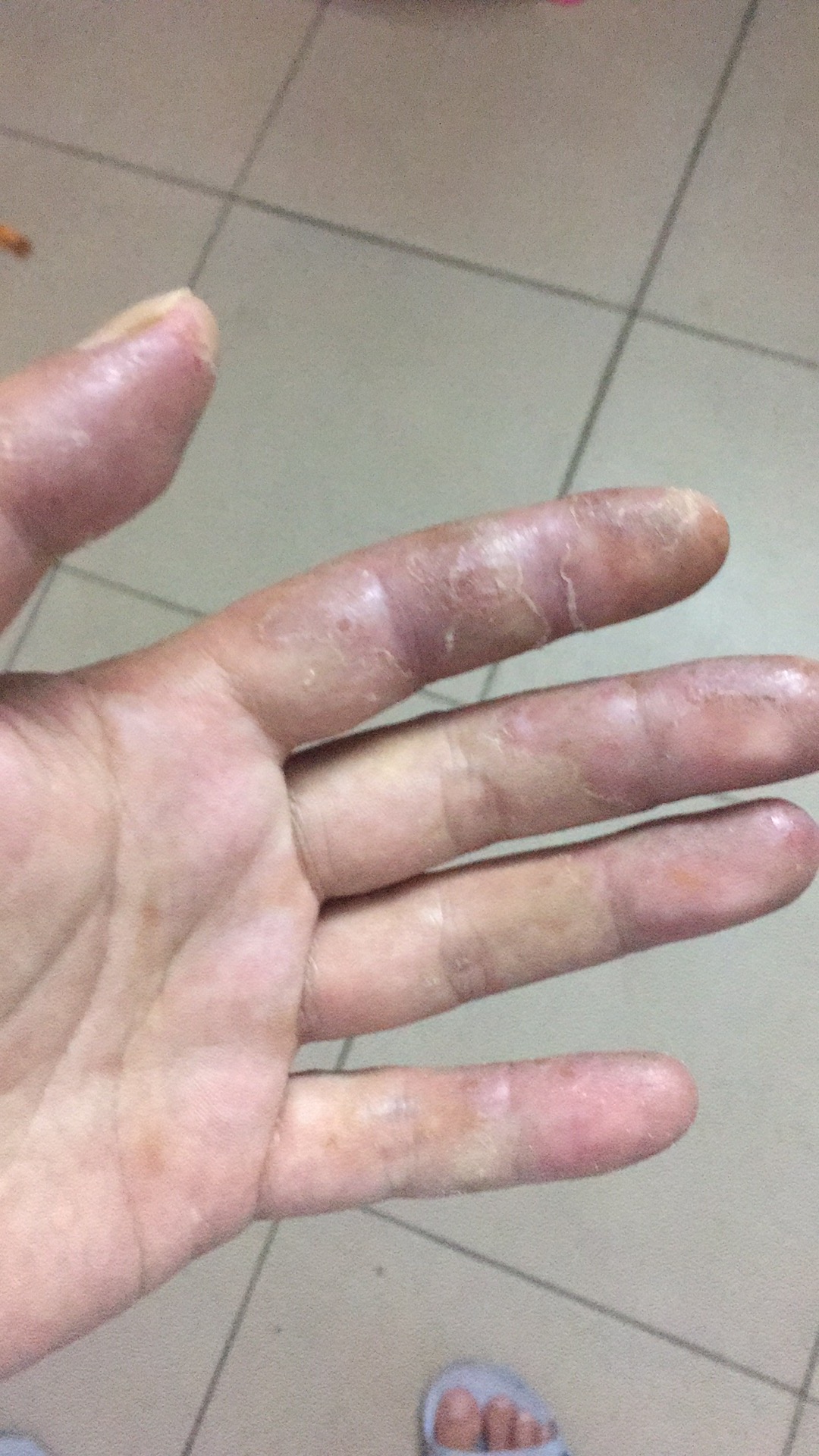 望大V能够分享一下|真实经历分享#钓鱼人#职业病之香虎手治疗方案