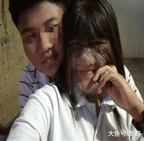 女孩突发怪病脸部疯狂生长,女孩患病满脸毛发