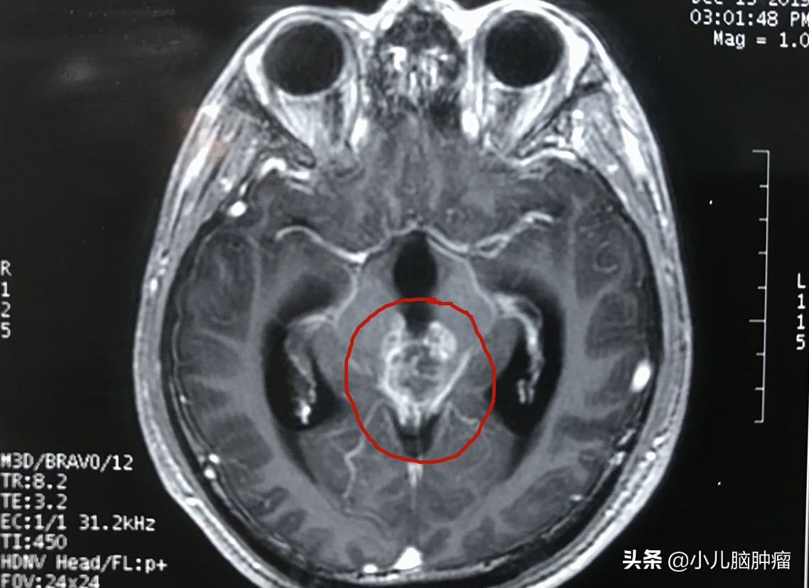 一例位于松果体区和三脑室内的肿瘤
