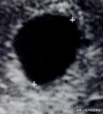 内见卵黄囊,卵黄囊肿瘤