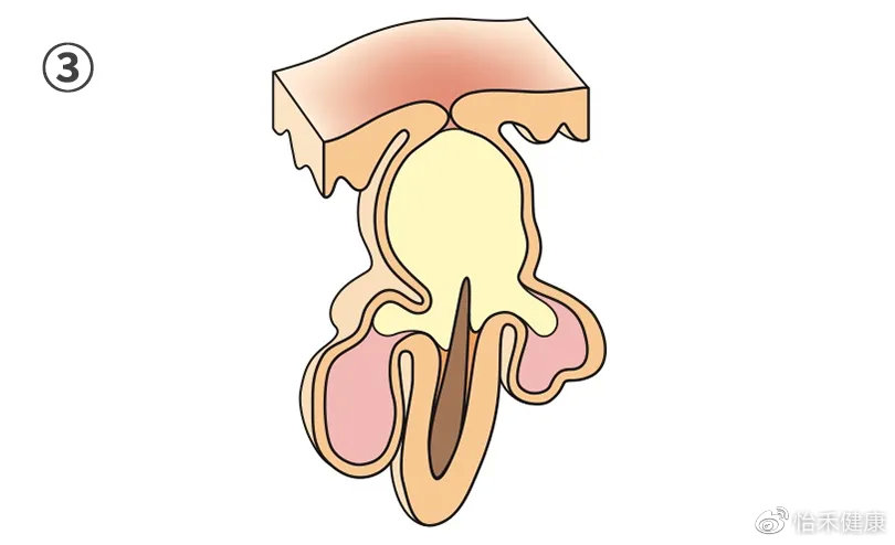 你以为的黑头真的是黑头吗,讨厌的黑头真的会变成草莓鼻吗