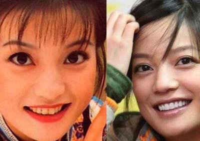 吴宣仪烤瓷牙怎么做,吴宣仪的整牙前