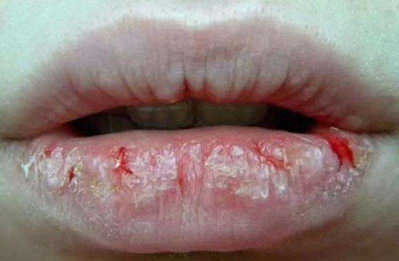 唇炎患者也可以用的润唇膏,唇炎可以用的唇膏推荐