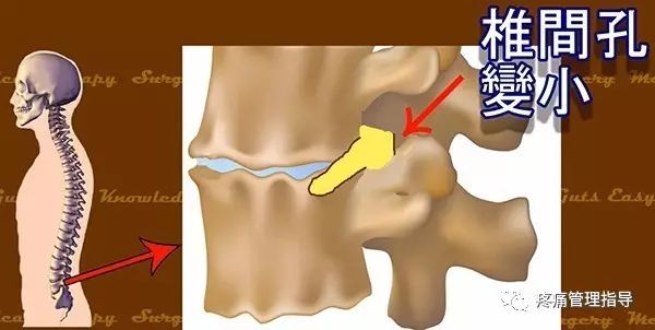 72岁老人腰疼还有骨刺该怎么治疗,老年人骨刺疼痛怎么治疗