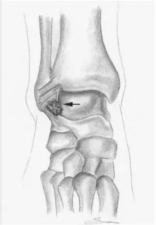 踝关节撞击症问诊,踝关节内侧撞击综合症位置图