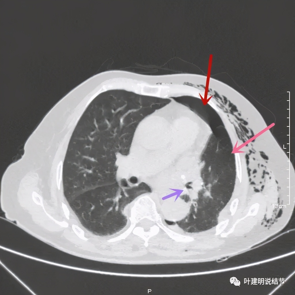 中央型肺癌手术前辅助治疗,中央型肺癌治疗后活过10年的病例