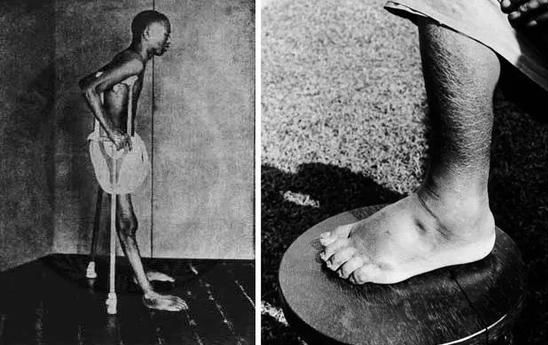 区区一个脚气病,差点灭掉日本*队军**,还改变了日本的国运……