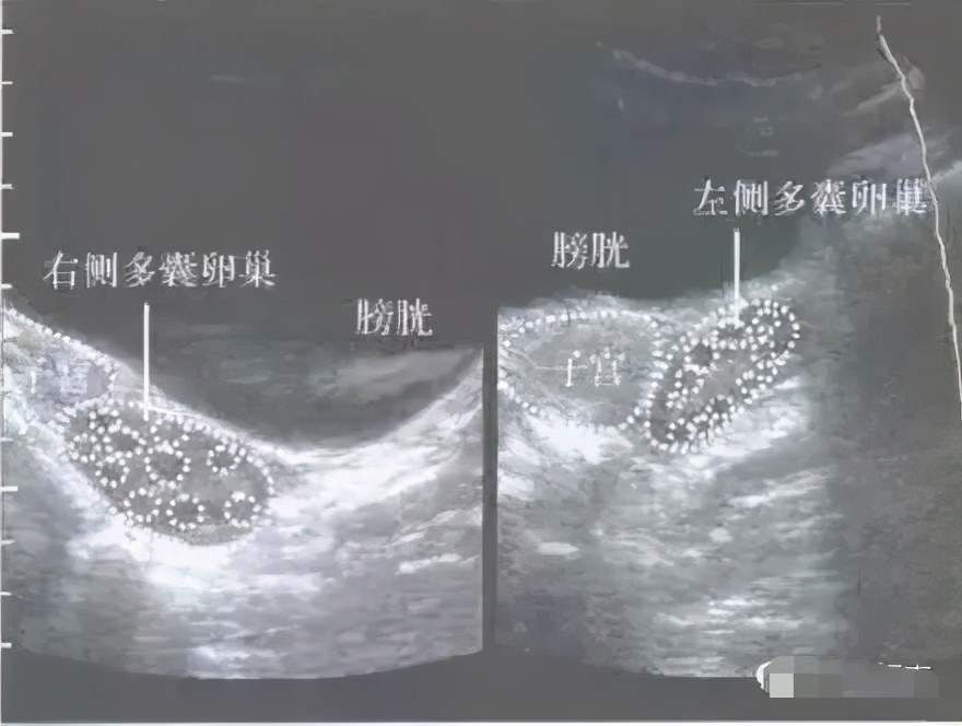 b超检查卵巢有低回声团块是什么,b超查出卵巢多囊就一定准确吗