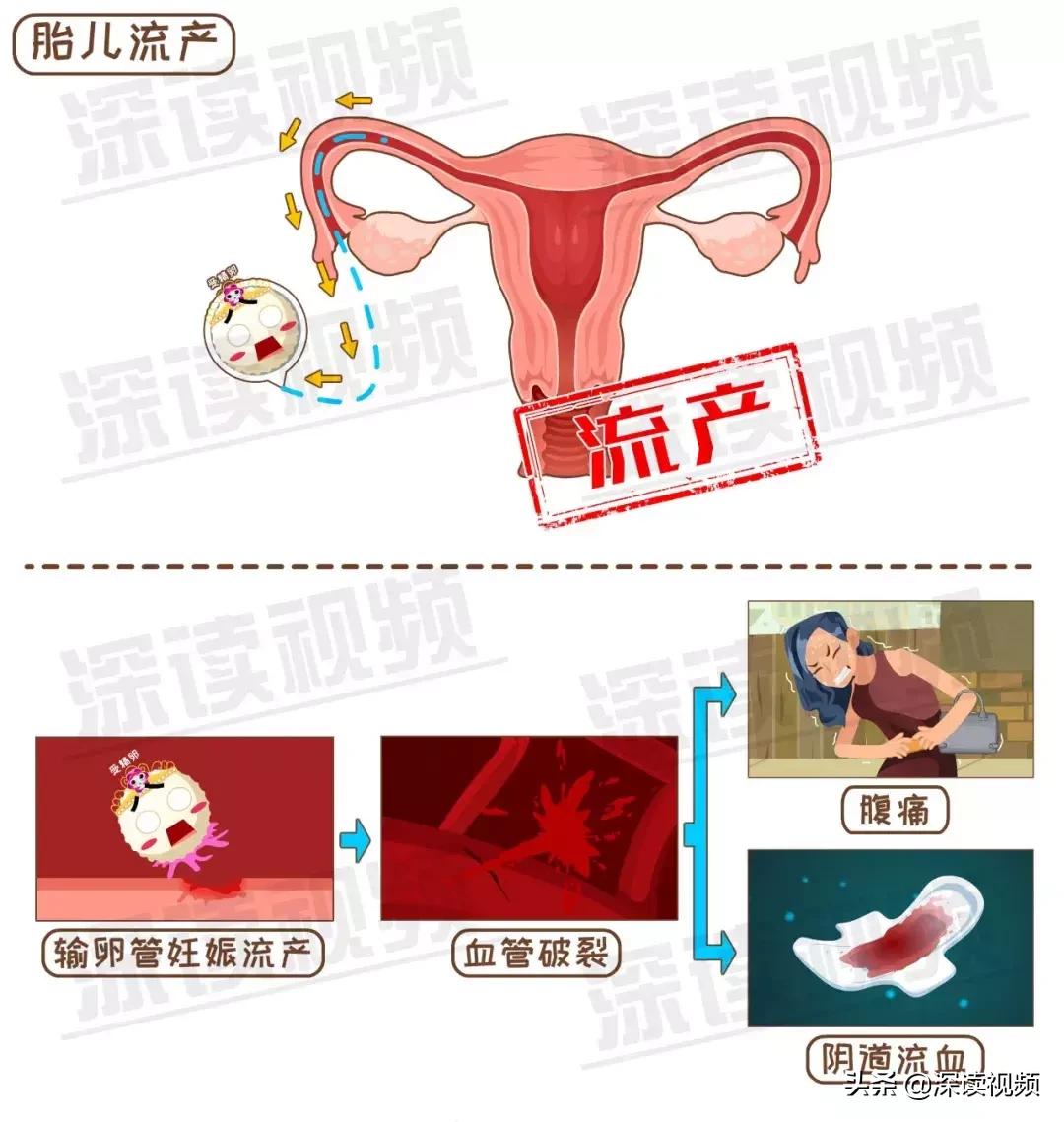 宫外孕和男性不良习惯有关系吗,这些习惯会导致不孕