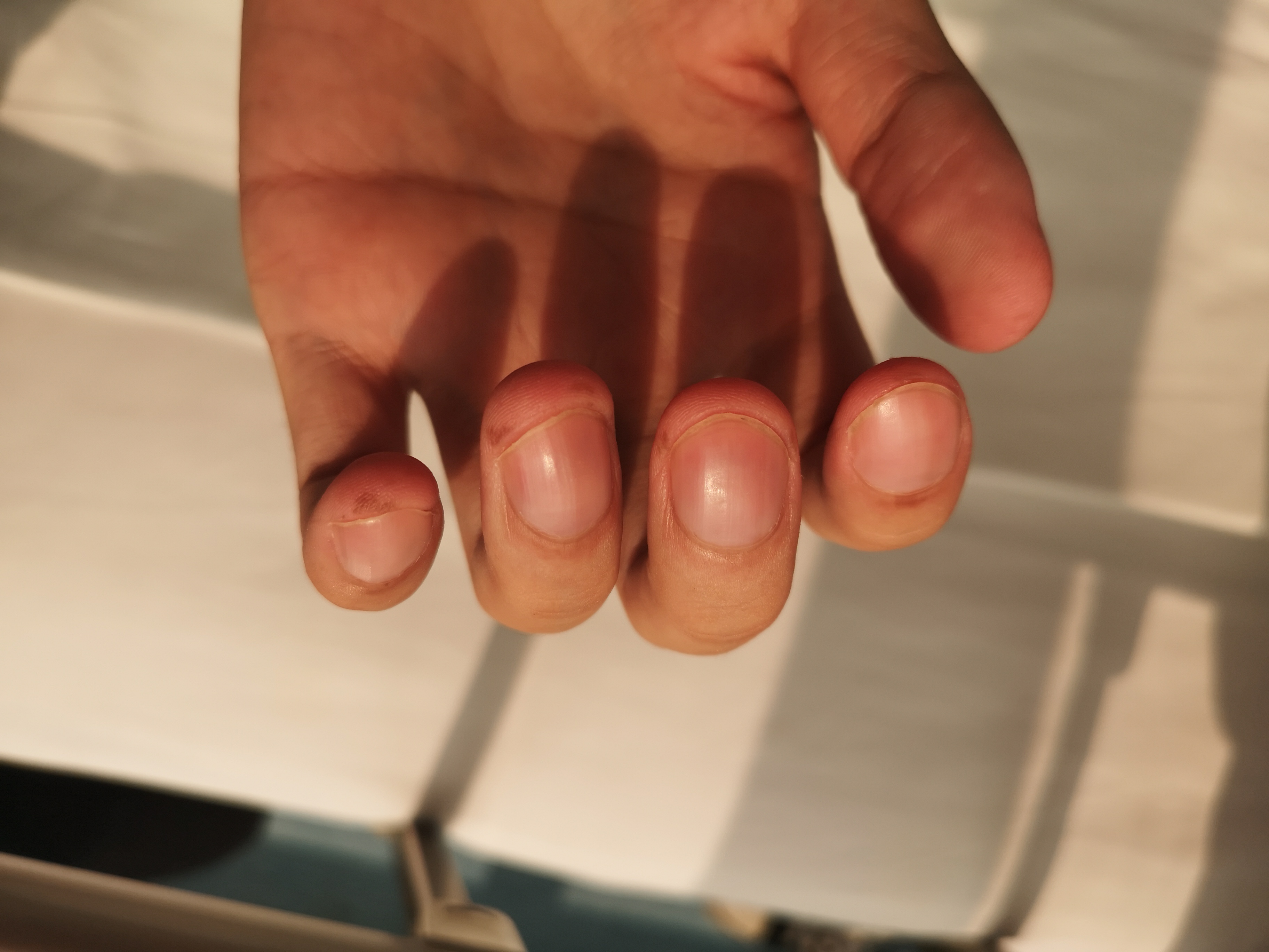 警惕这种黑痣可能是恶性肿瘤,这些地方有黑痣要注意了