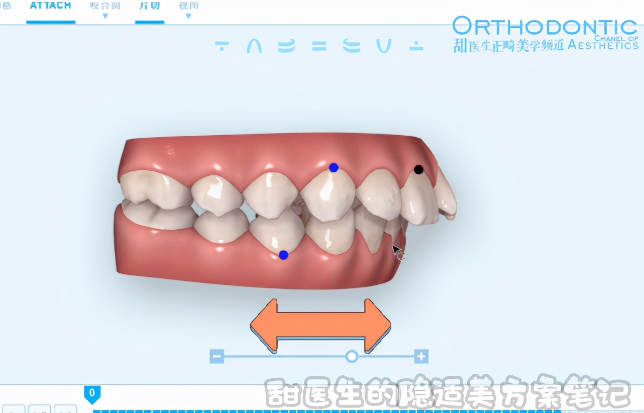 下颌后缩、咬合不对位，能用隐适美矫正吗？曹甜博士视频讲解案例