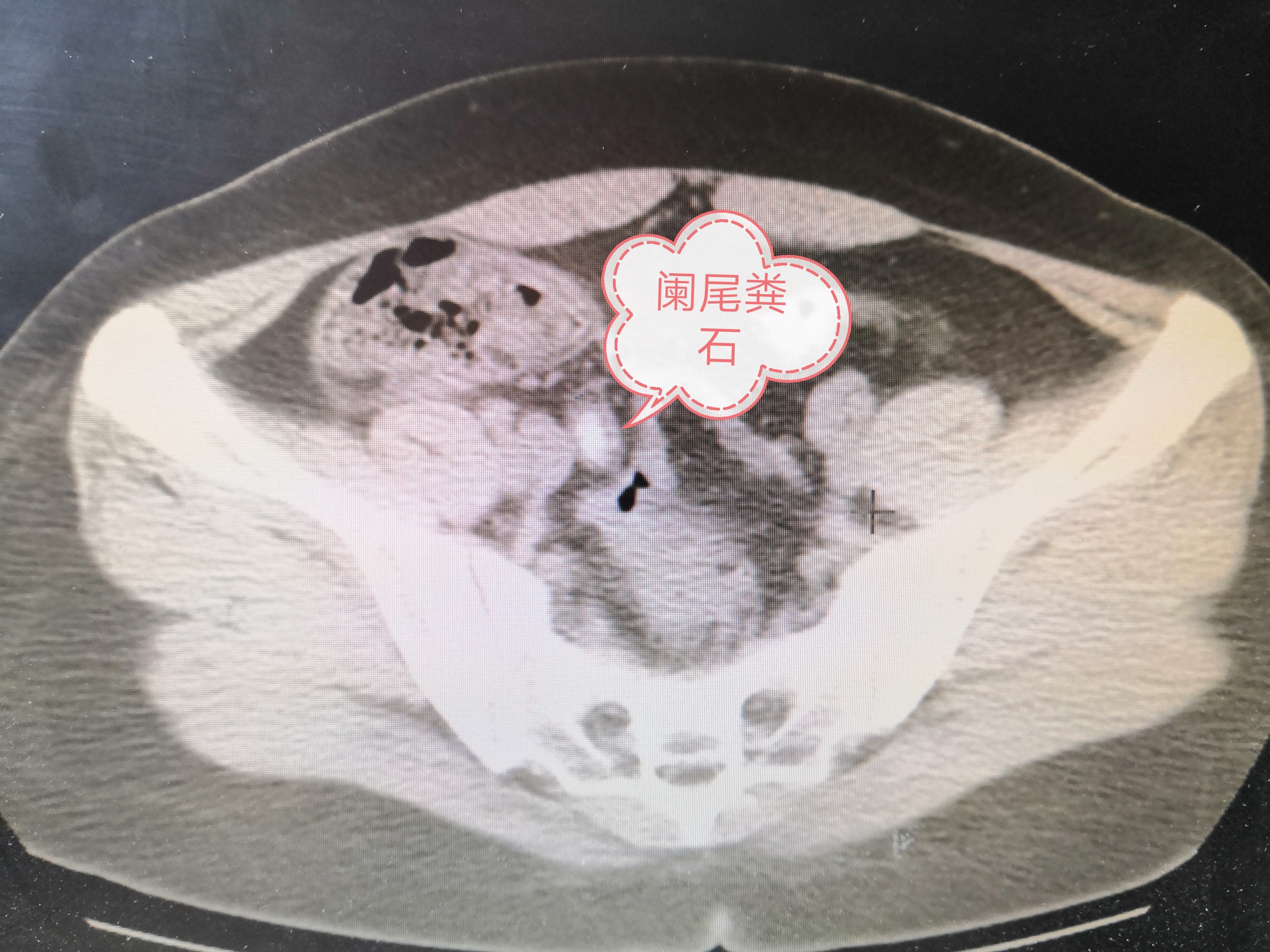 急性化脓性阑尾炎保守治疗要多久,急性阑尾炎脓肿保守治疗多久出院