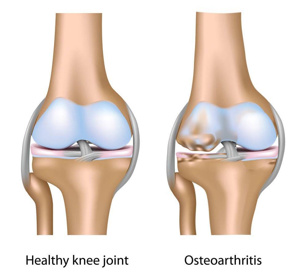 骨关节炎痛风和类风湿都有何症状,痛风关节严重畸形患者能活多久