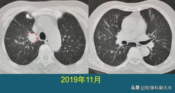 三种情况发现是肺癌晚期,晚期肺癌不咳嗽爱睡觉是怎么回事