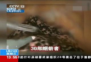 戒烟之后,变黑的肺还能白回来吗?