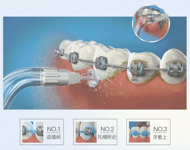 矫正牙齿反弹几率多大,矫正牙齿后没戴保持器反弹了