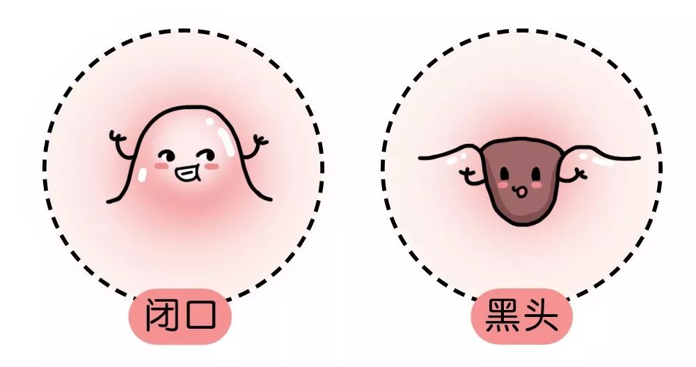 试试这3招很有效的去黑头小妙招,一招教你消灭黑头