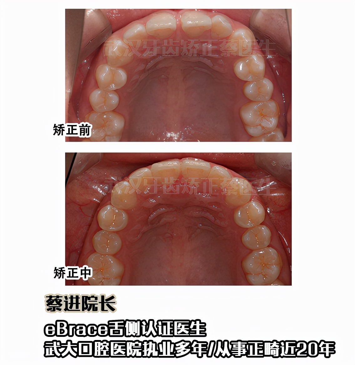 武汉矫正牙齿去哪里做最好,武汉成人牙齿矫正牙齿不齐
