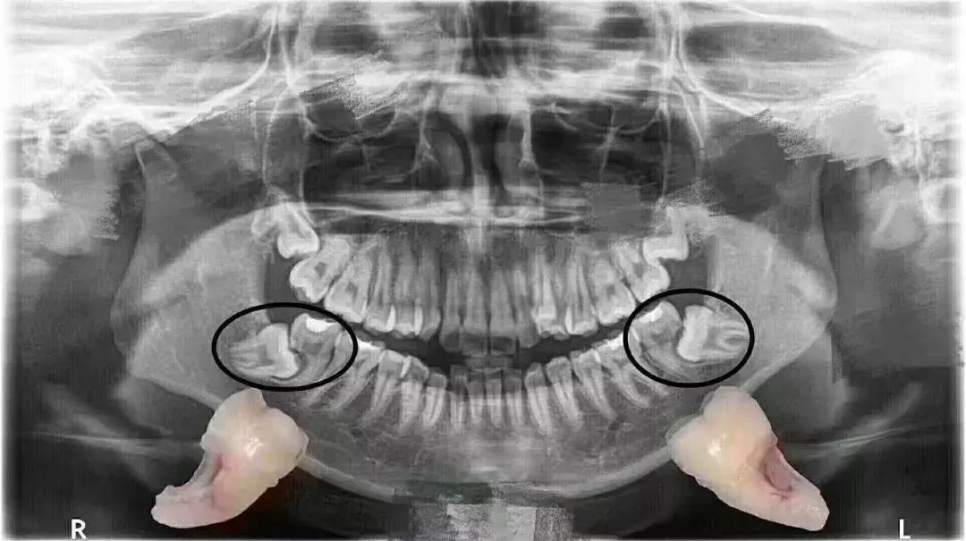 那些不拔智齿的人后来都怎么样了,那些该拔不拔的智齿最后都咋样了
