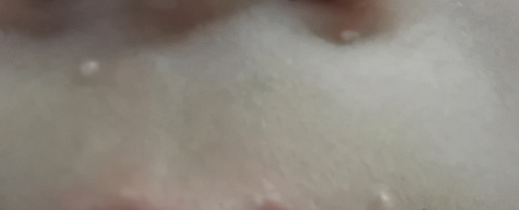 脸上长了闭口小颗粒怎么去除,脸上长白色小颗粒怎样去除掉