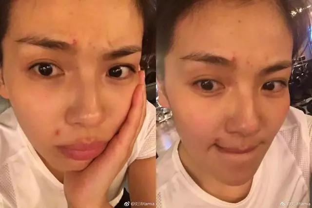 脸上老是长痘痘用什么药,脸上痘痘反复最快的解决方法