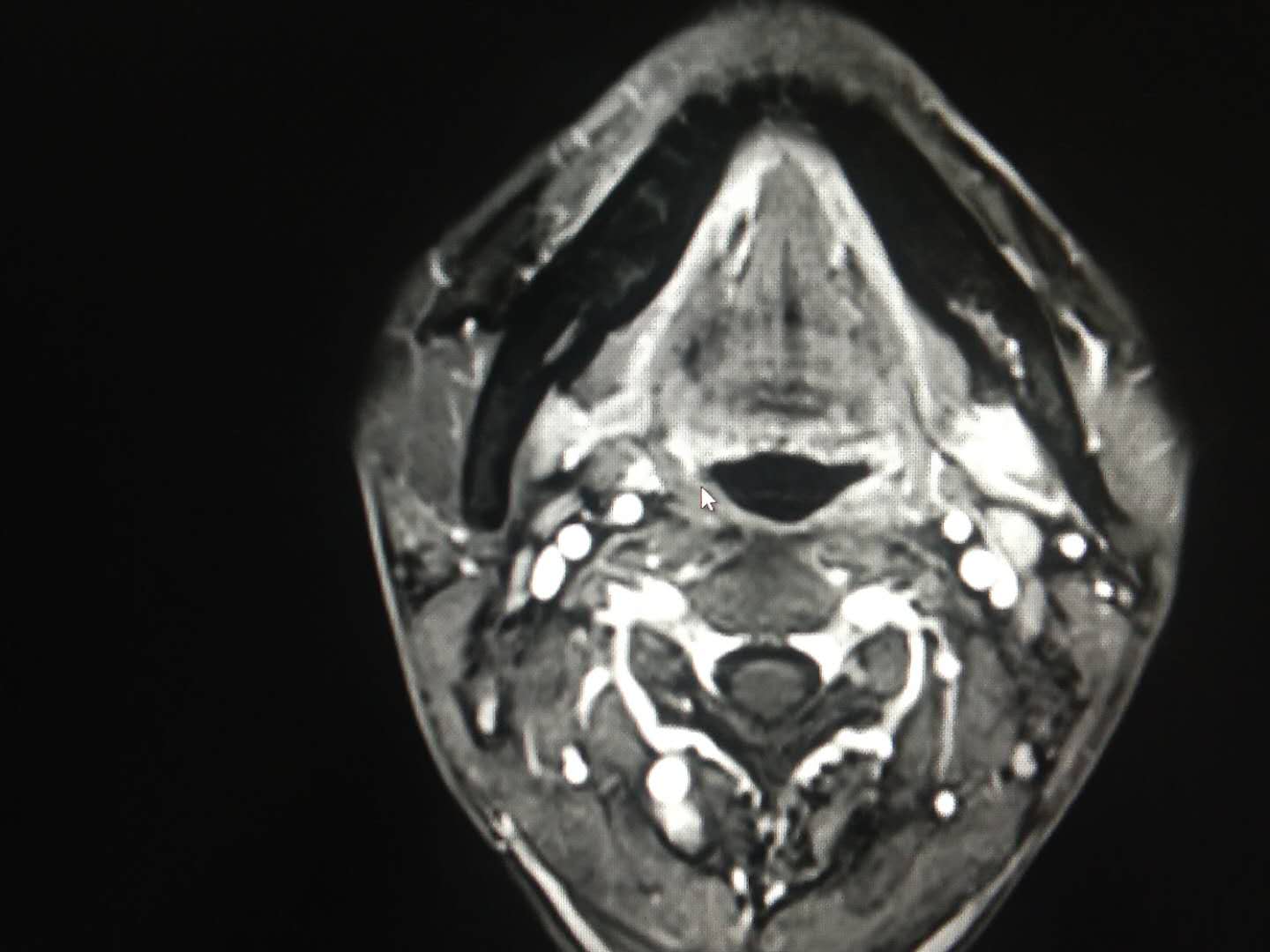 求助鱼刺卡喉偏方,续三