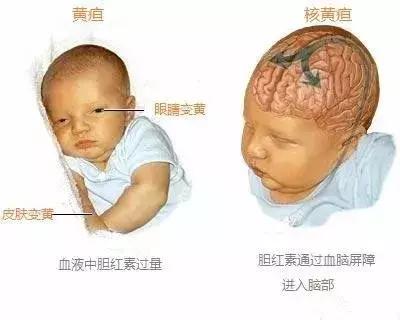 黄疸治疗不及时,宝宝居然会脑瘫?