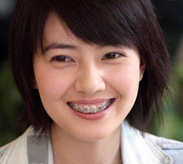 吴宣仪烤瓷牙怎么做,吴宣仪的整牙前