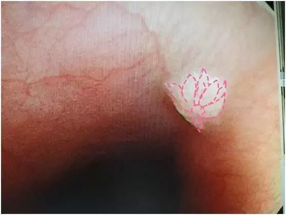 食管壁上美丽的“莲花”在无痛胃肠镜下现出了魔影