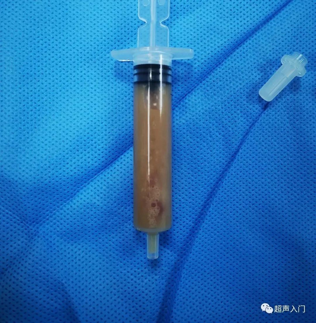 急性胆囊炎超声表现入门教学视频,急性胆囊炎超声诊断怎么写