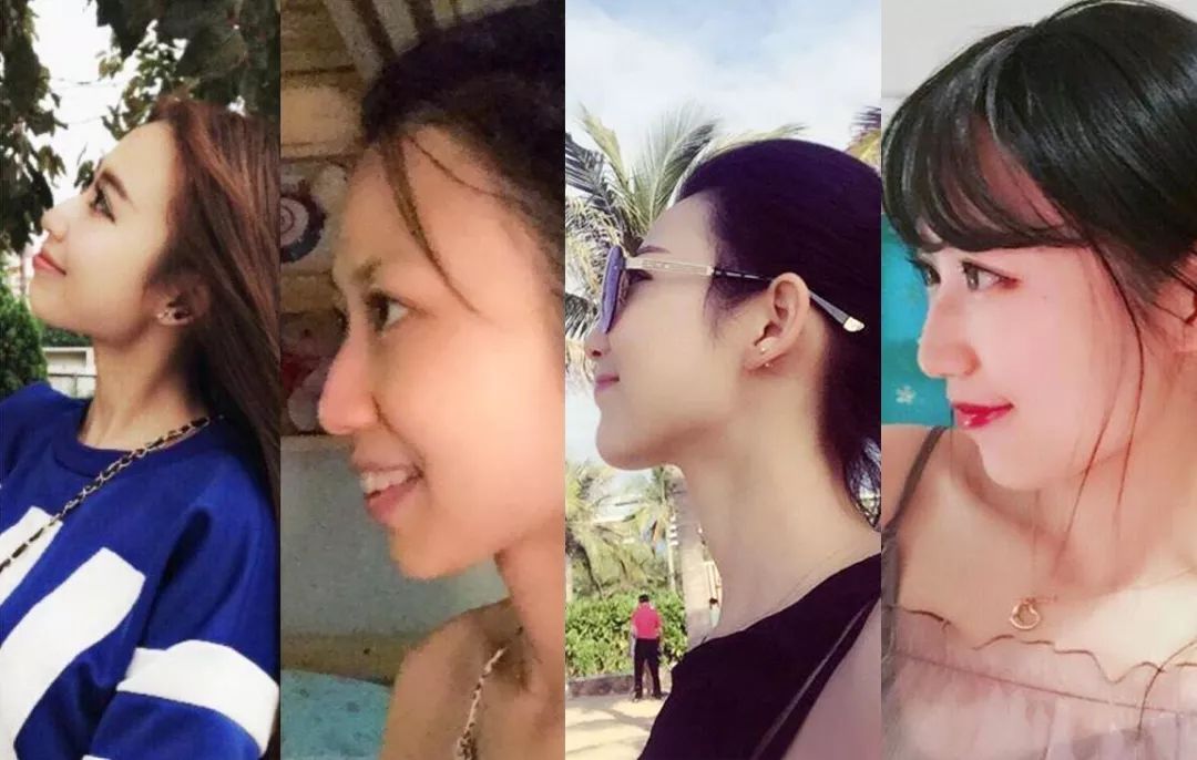 龅牙矫正前后对比照片,龅牙修复效果图