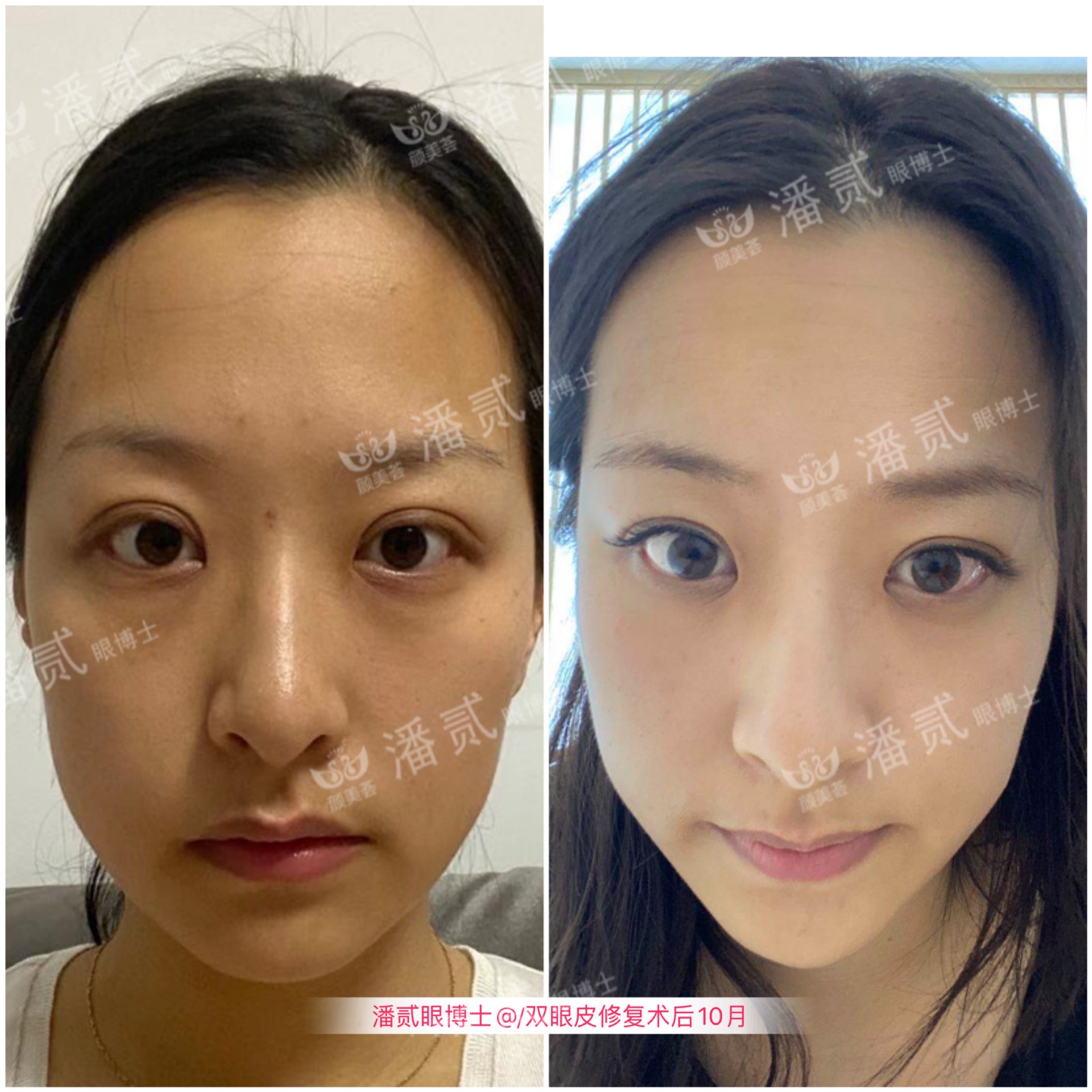 双眼皮失败的女孩,双眼皮失败做成了三眼皮好修复吗