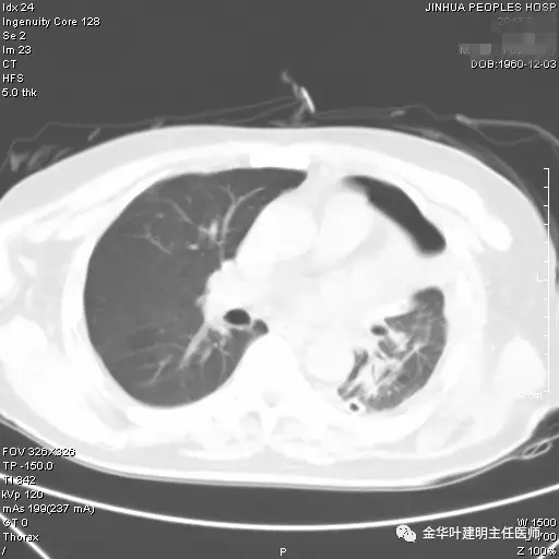 不典型鳞状细胞不明确可怕吗,不典型性鳞癌是什么