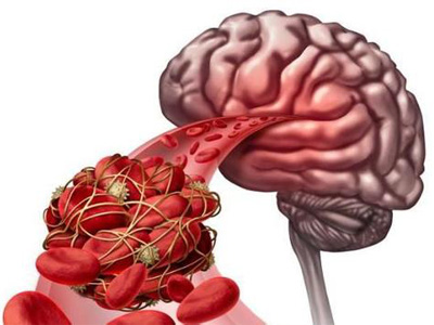 放血能治血栓吗,放血能防止脑梗吗