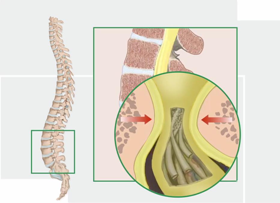 老人腰椎狭窄能做手术吗,腰椎椎管狭窄在什么情况下才手术