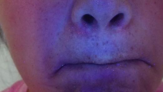 为什么身上出现很多白斑怎么治疗,白斑经过治疗后边缘发黑是为什么