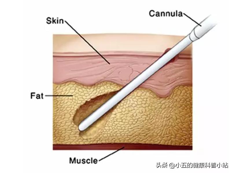 什么叫做脂肪瘤该怎么医治,脂肪瘤有什么危害脂肪瘤最怕什么