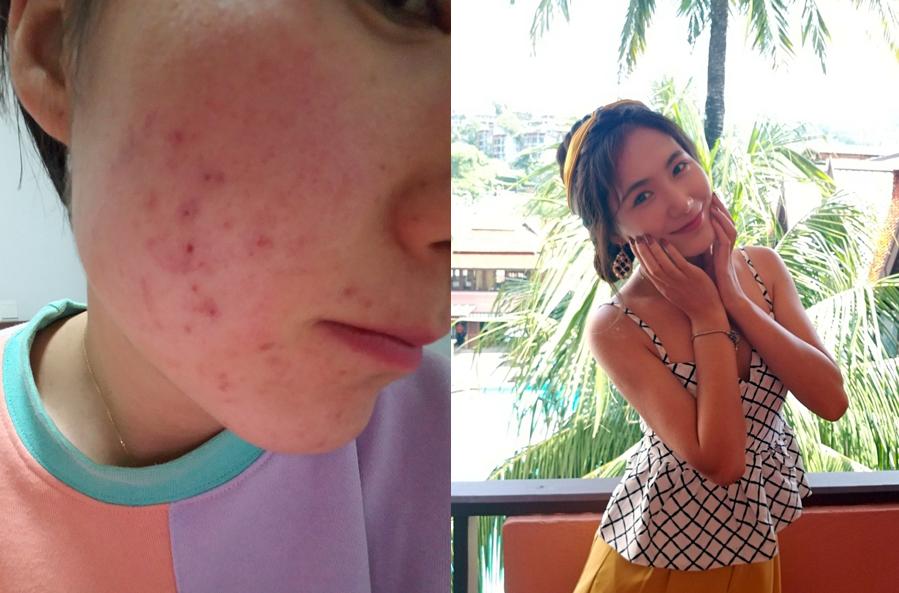 敏感肌修护烂脸推荐,泛红敏感肌修复抗老