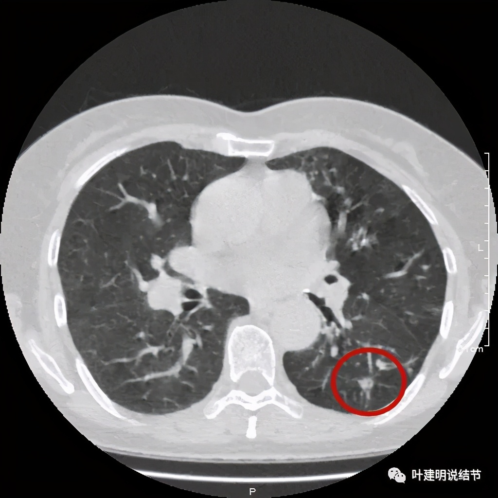 这样的实性结节伴小空洞会是肺癌吗?
