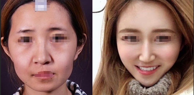 面部脂肪填充会改善皱纹吗,面部脂肪填充会吸收多少