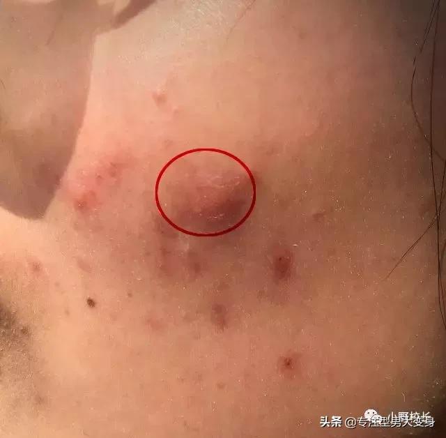 长痘正确挤痘方式,长痘能挤掉吗