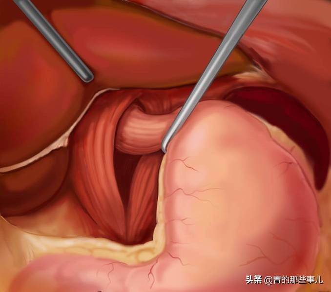 每次饭后胃胀怎么办,每次饭后胀气