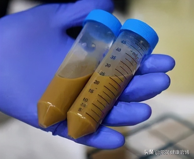 粪菌移植癌症,粑粑也能治病