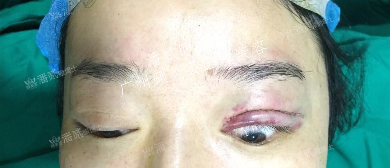 提肌矫正失败的表现眼皮睁不开,做完提肌眼睛前半段下垂