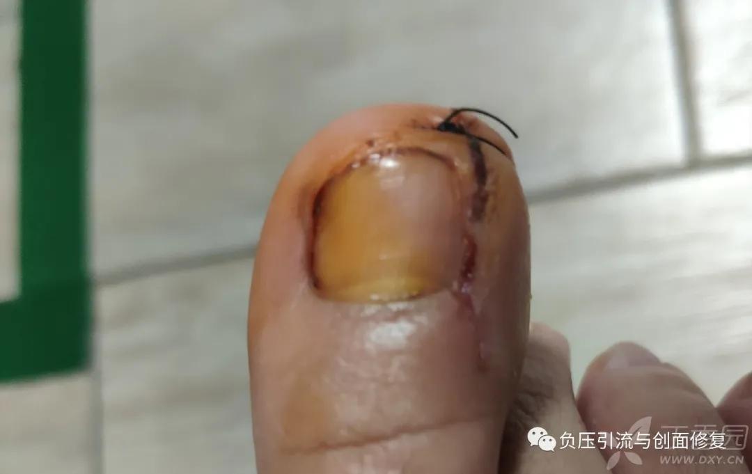 自己剪掉甲沟炎肉芽自己会消掉吗,甲沟炎拔甲后复发的几率多大