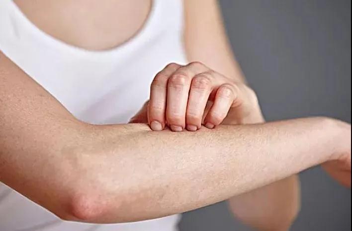 科普一下荨麻疹银屑病,银屑病科普宣传早期使用生物制剂