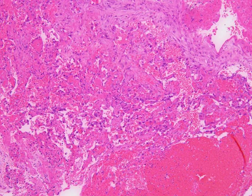 弥漫性肺泡出血是怎么回事,弥漫性肺泡出血症病因分类